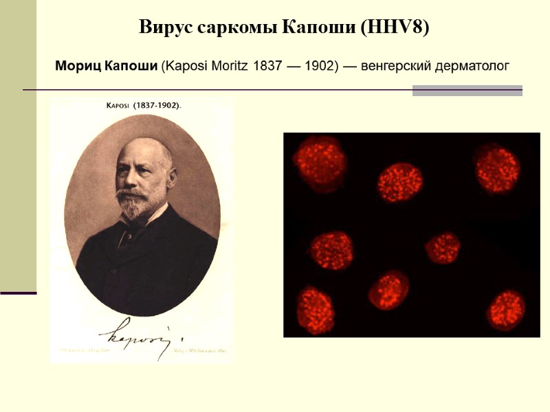 Вирус саркомы Капоши (HHV8) Мориц Капоши (Kaposi Moritz 1837 — 1902) — венгерский дерматолог
